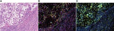 Clinical implications of the tumor microenvironment using multiplexed immunohistochemistry in patients with advanced or metastatic renal cell carcinoma treated with nivolumab plus ipilimumab